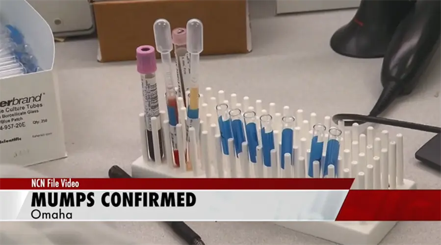 Case of mumps confirmed at center near UNO