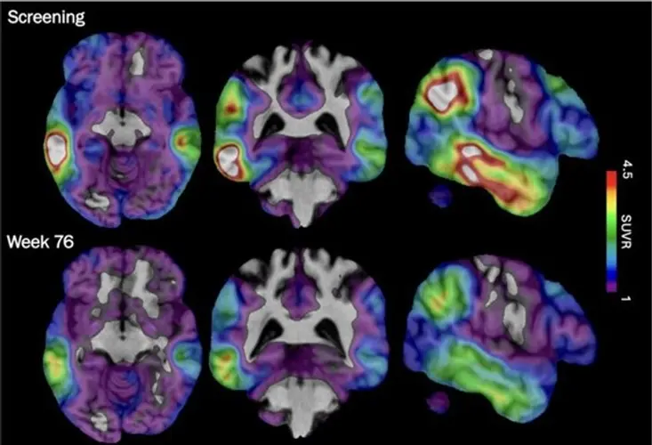 An experimental Alzheimer's drug shows promise targeting a different brain protein, new study shows