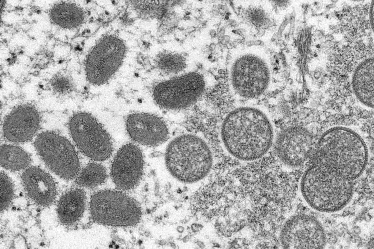 Kansas identifies state’s 1st presumed case of monkeypox