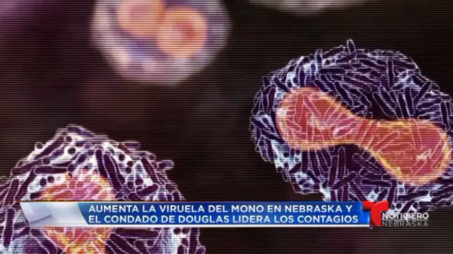 Aumenta la Viruela del Mono en Nebraska y el condado de Douglas lidera los contagios